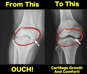 Rebuild Your Knees And Joints From The Inside Out With This New <nobr>Knee Candy</nobr>