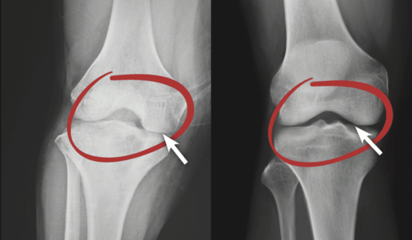 Rebuild Your Knees And Joints From The Inside Out With This New <nobr>Knee Candy</nobr>